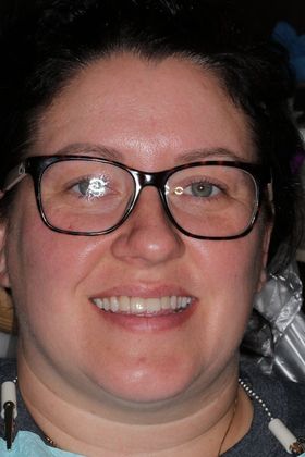 Veneers: Case 20 — before