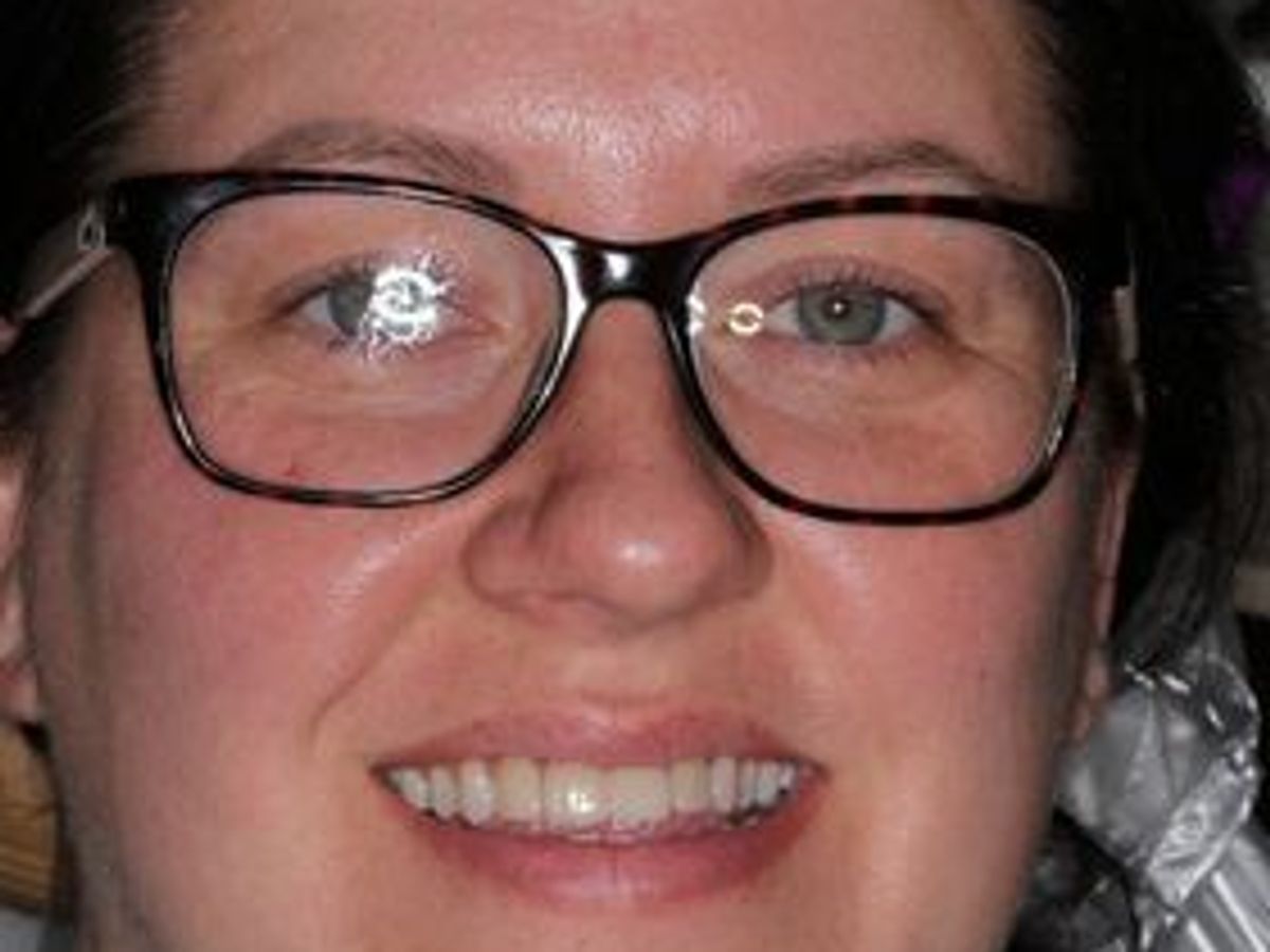Veneers: Case 20 — before