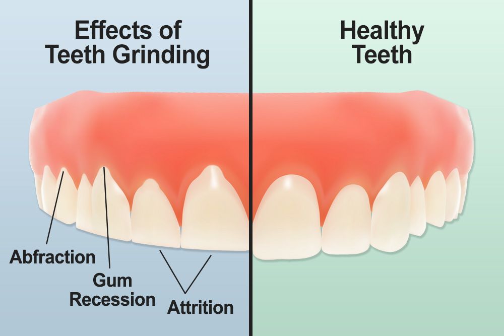 Protect the Teeth from Teeth Grinding