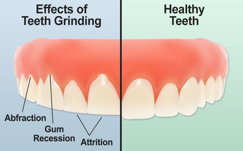 Protect the Teeth from Teeth Grinding