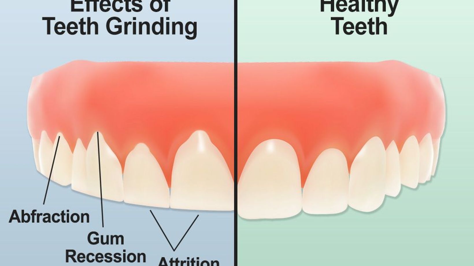 Protect the Teeth from Teeth Grinding