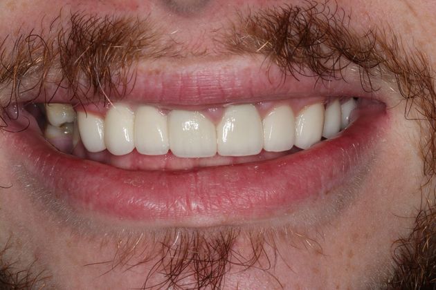 Dental Crowns: Case 31 — after