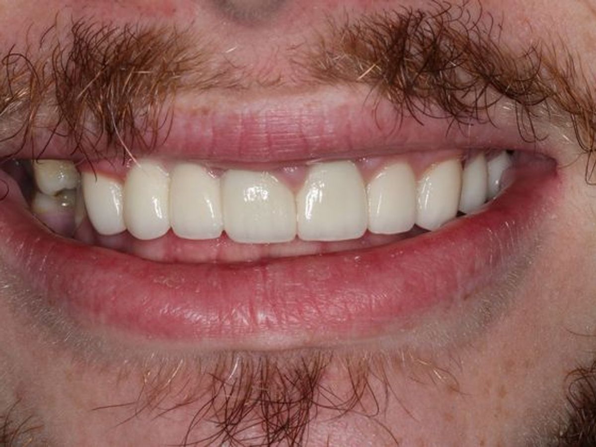 Dental Crowns: Case 31 — after