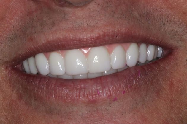 Teeth in a Day: Case 23 — Upper Lower Prosthetic / Prosthetic in Place after