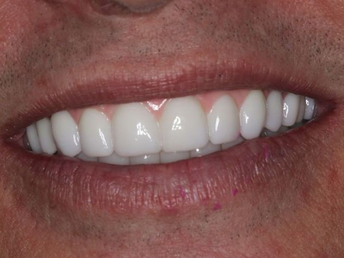 Teeth in a Day: Case 23 — Upper Lower Prosthetic / Prosthetic in Place after