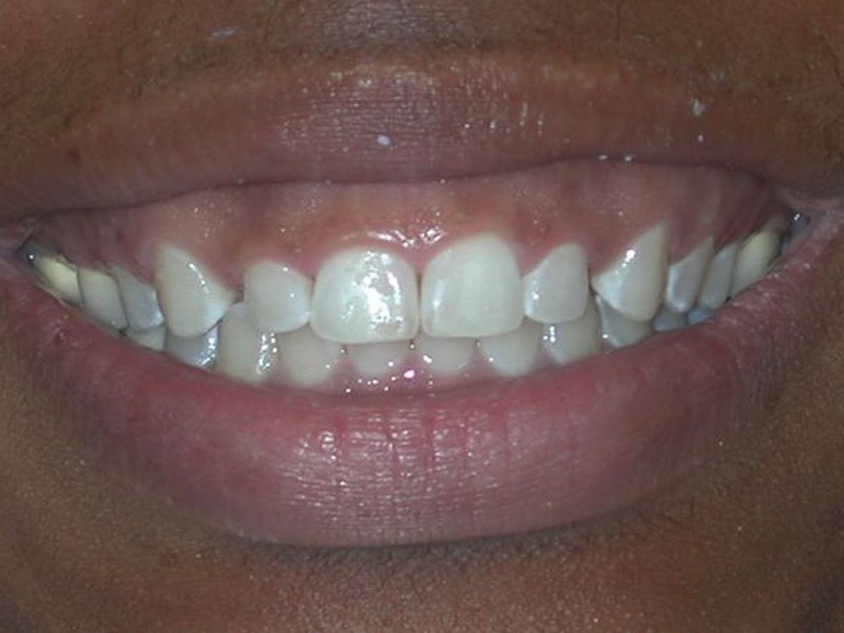Gum Lift: Case 7 — before