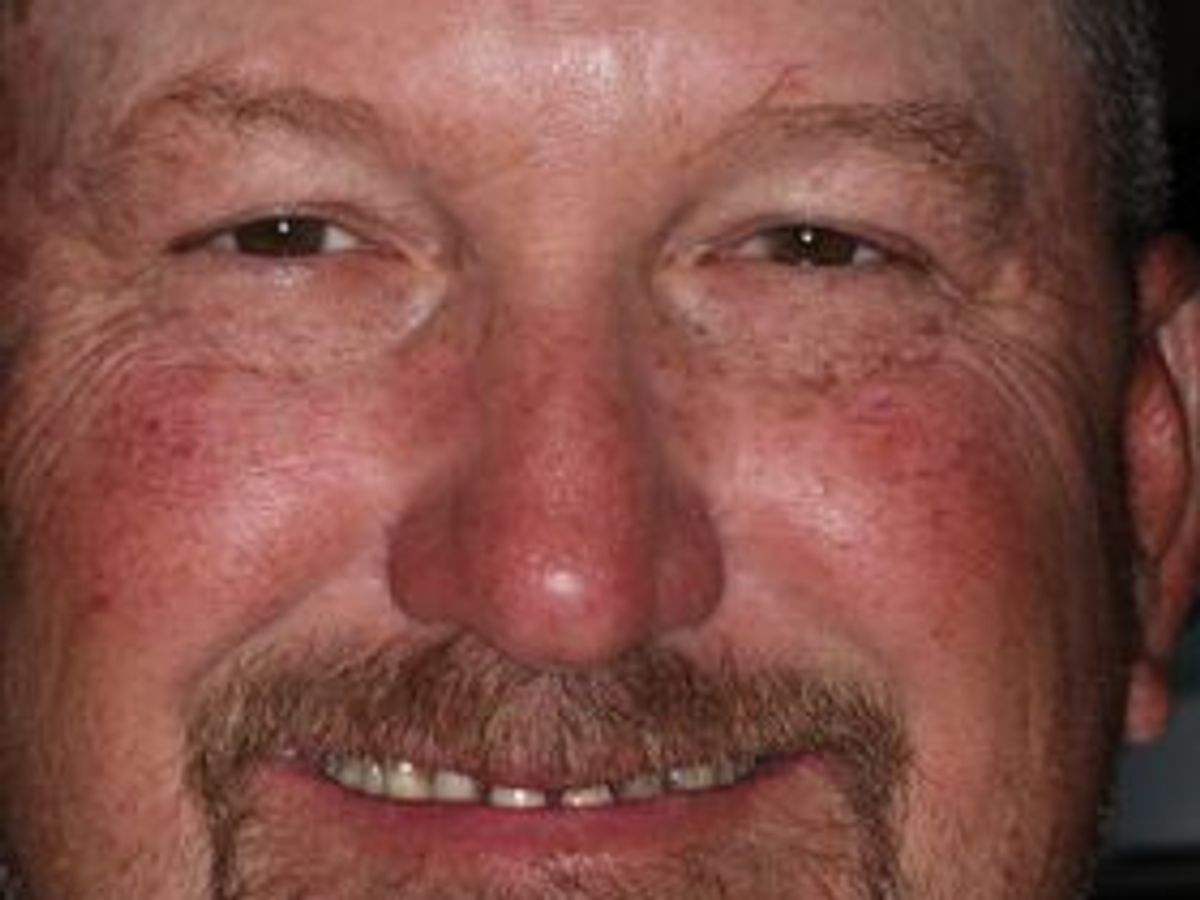 Veneers: Case 26 — before