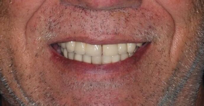Dental Implants: Case 11 — before