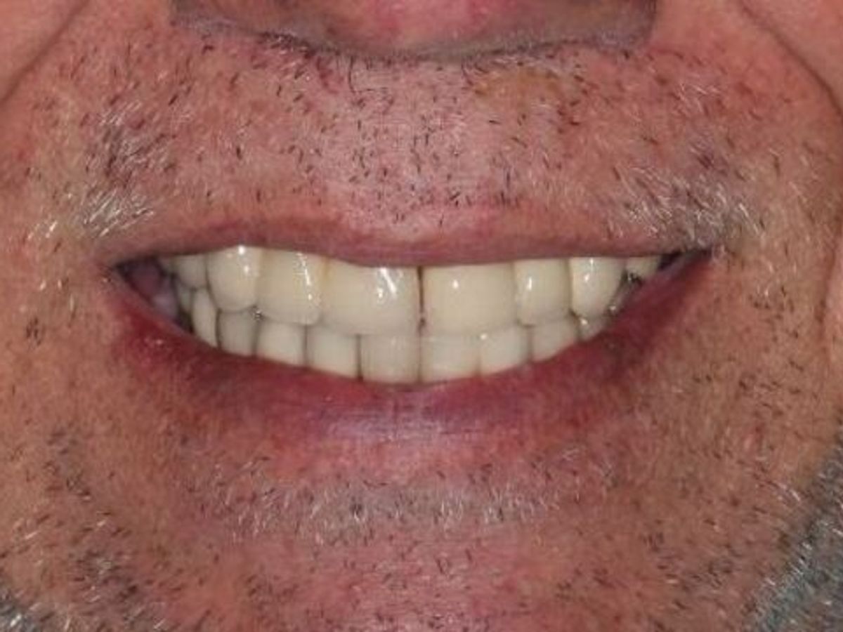 Dental Implants: Case 11 — before
