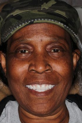 Veneers: Case 21 — after
