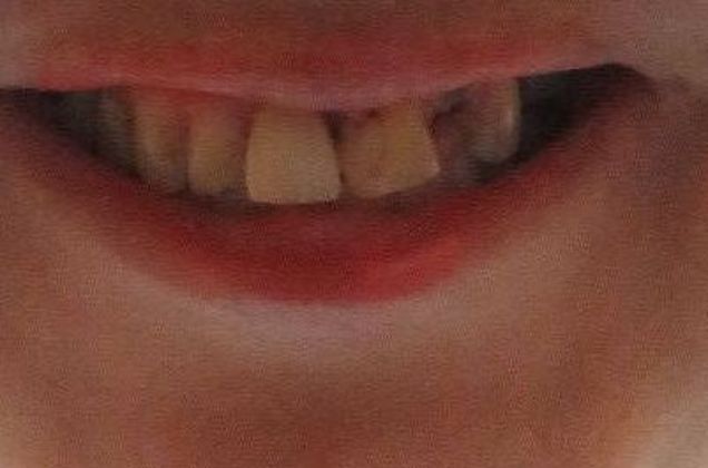 Dental Crowns: Case 28 — before