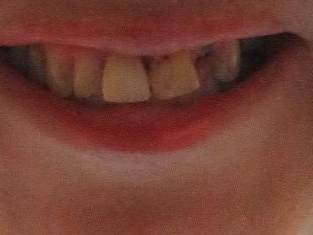 Dental Crowns: Case 28 — before