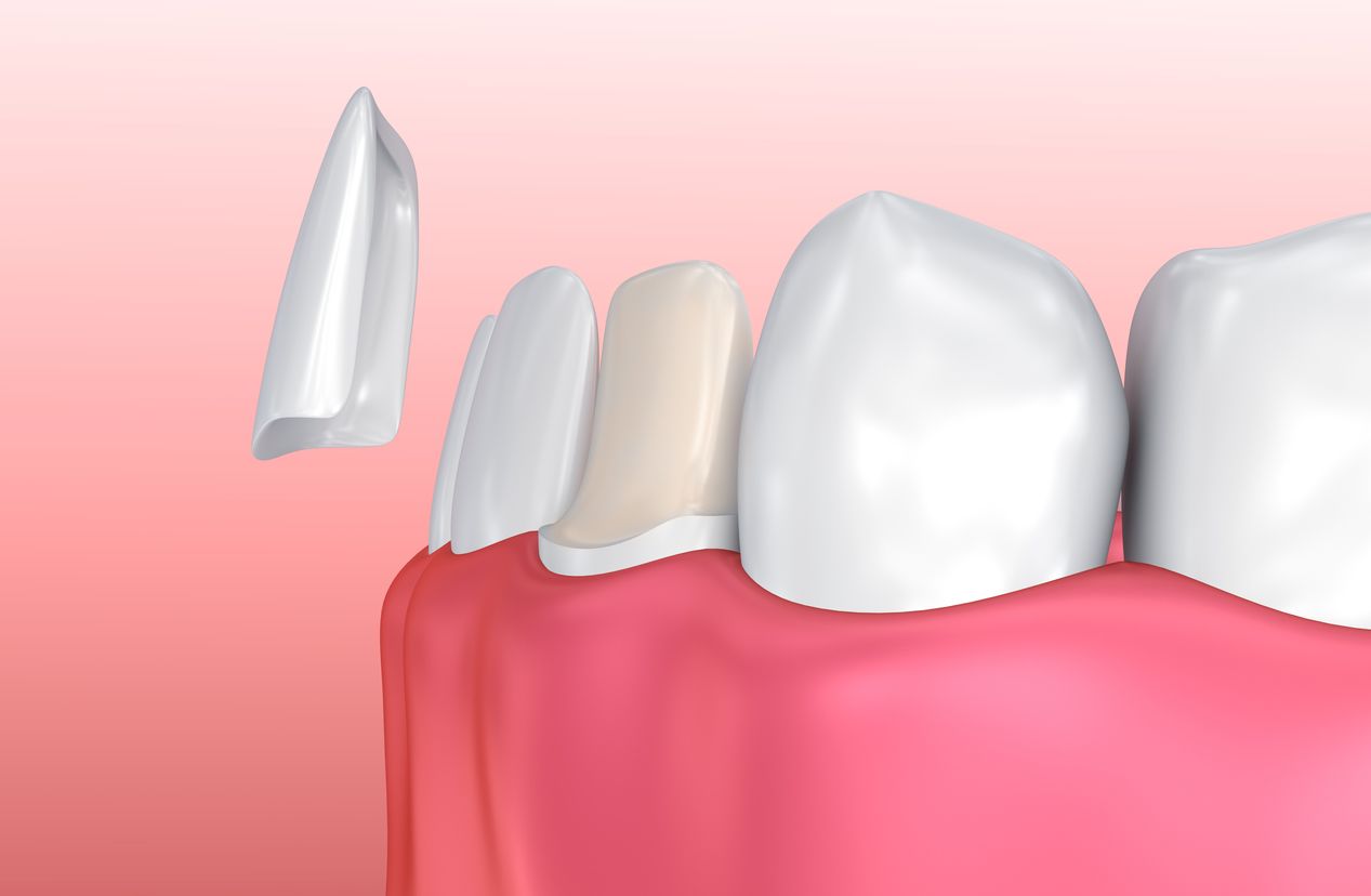 How Long Does it Take to Adjust to Veneers?