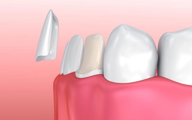 How Long Does it Take to Adjust to Veneers?