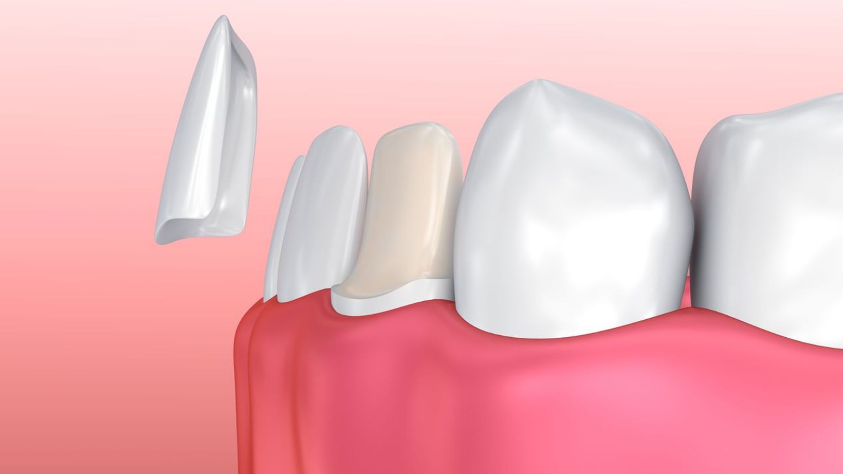 How Long Does it Take to Adjust to Veneers?