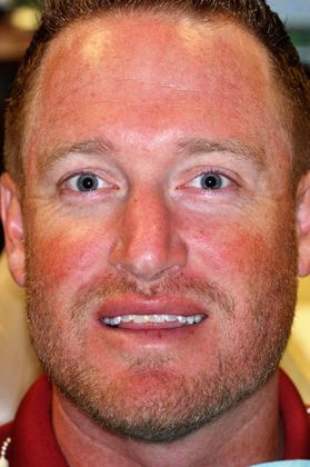 Veneers: Case 18 — before