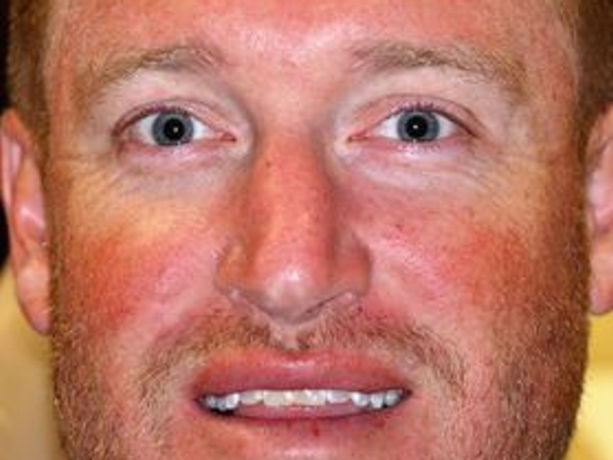 Veneers: Case 18 — before