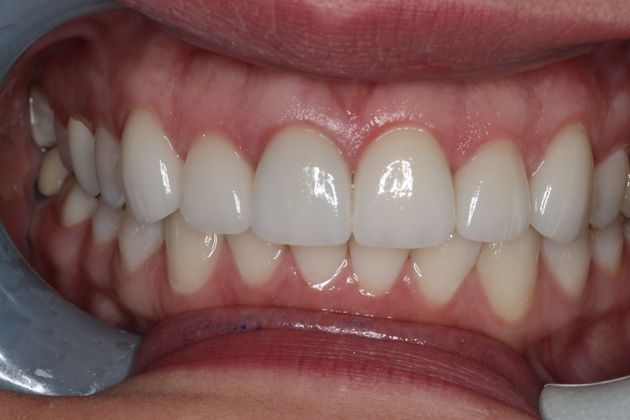 Dental Crowns: Case 5 — after