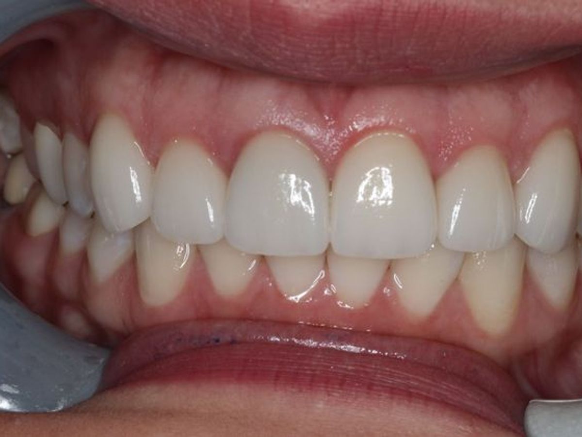 Dental Crowns: Case 5 — after