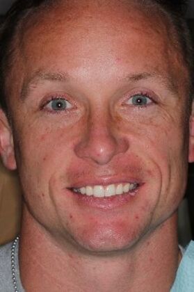Invisalign: Case 1 - before