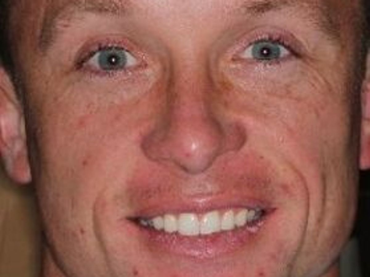 Invisalign: Case 1 — before