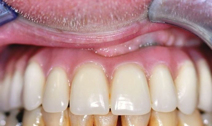 Teeth in a Day: Case 13 — Upper Arch after