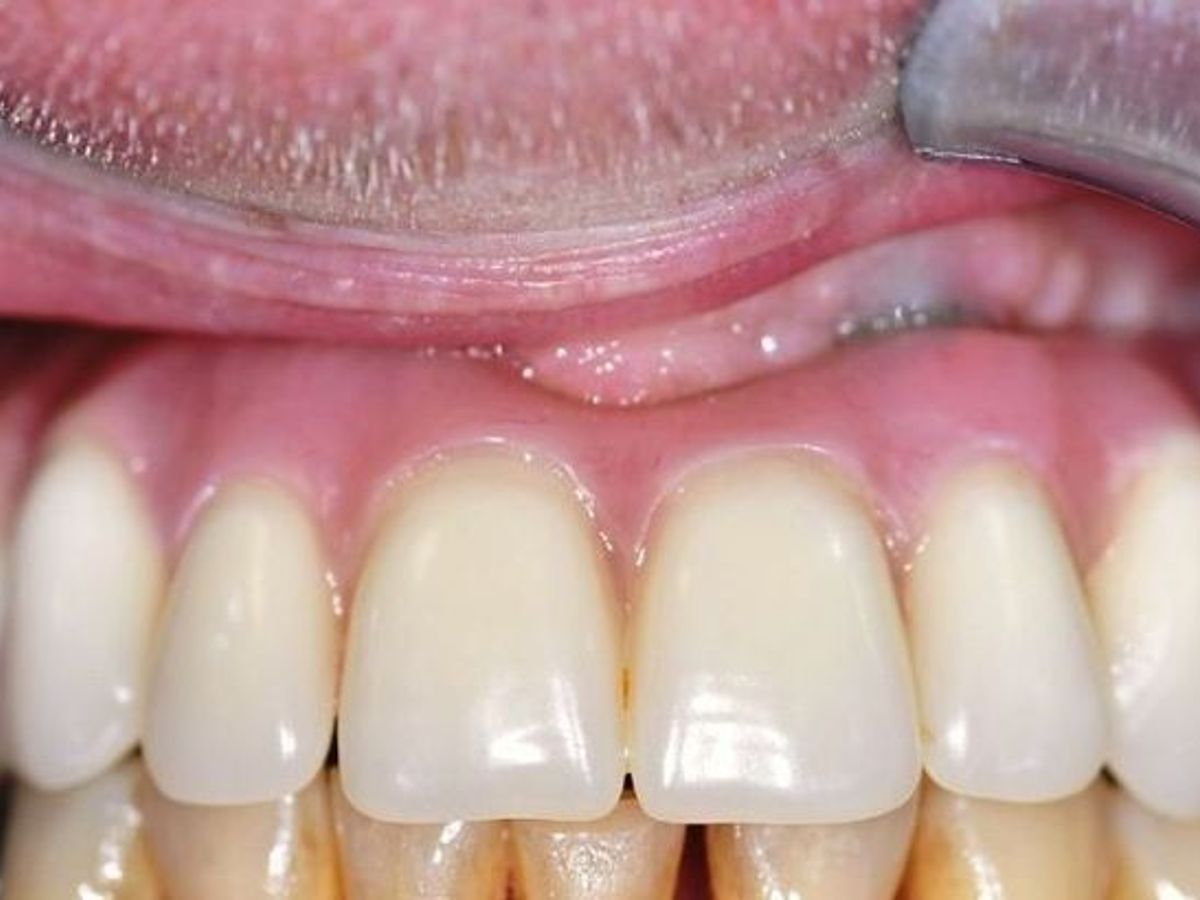 Teeth in a Day: Case 13 — Upper Arch after