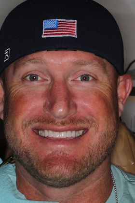 Veneers: Case 18 — after