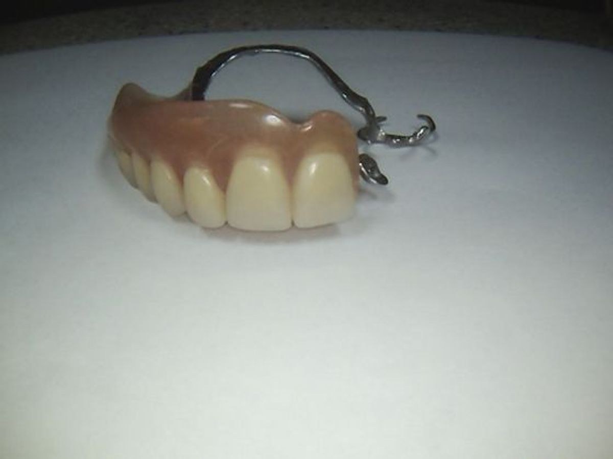 Dental Implants: Case 10 — Locator Abutments / Upper Partial Denture after