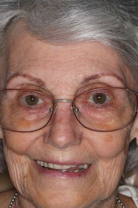 Dentures: Case 12 — before