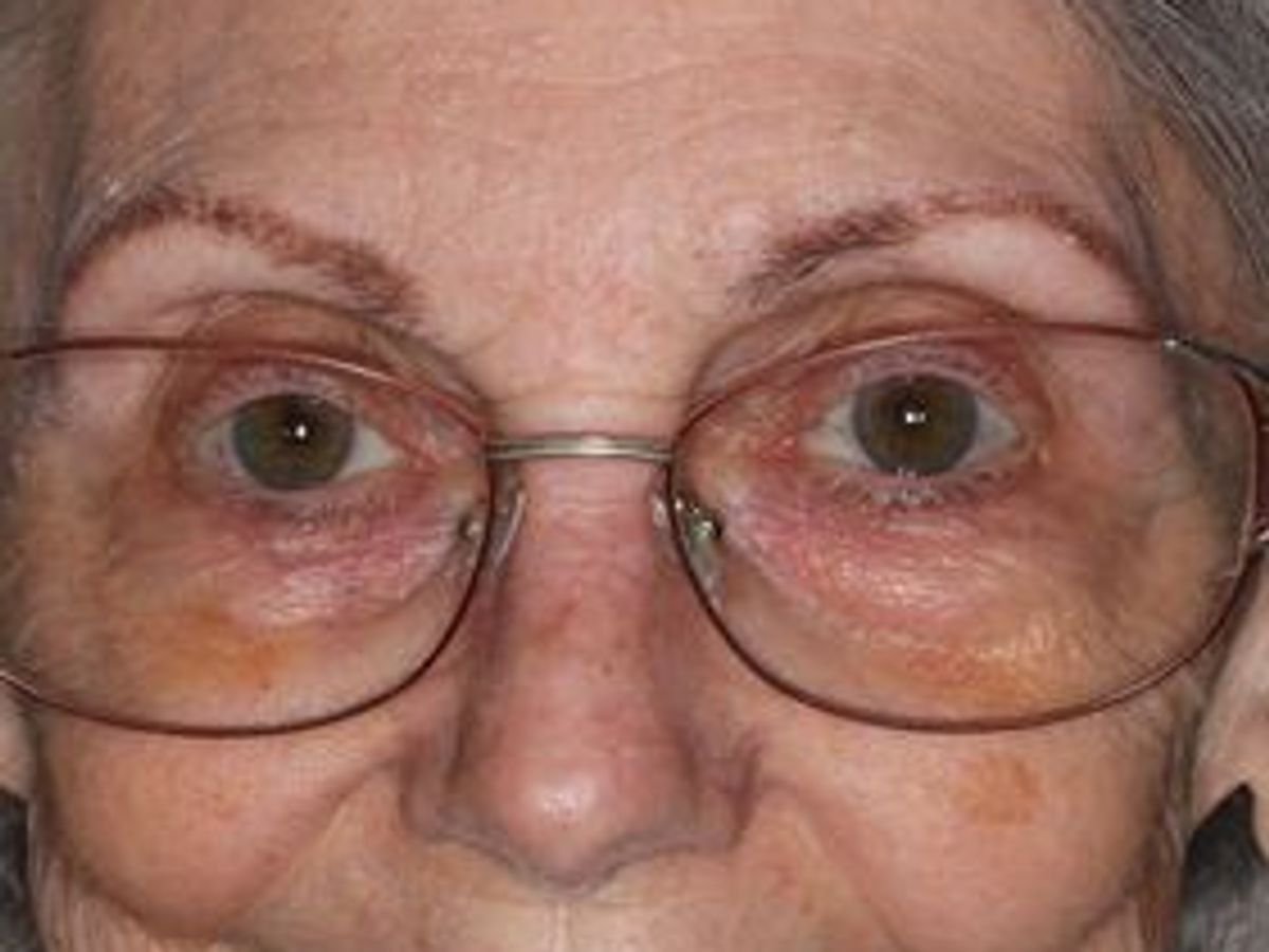 Dentures: Case 12 — before