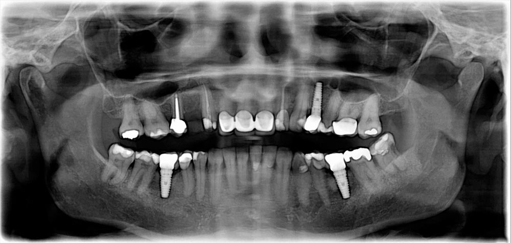 A Closer Look at the Dental Implant Timeline