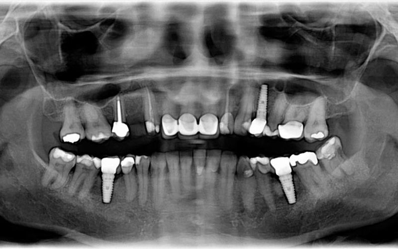 A Closer Look at the Dental Implant Timeline