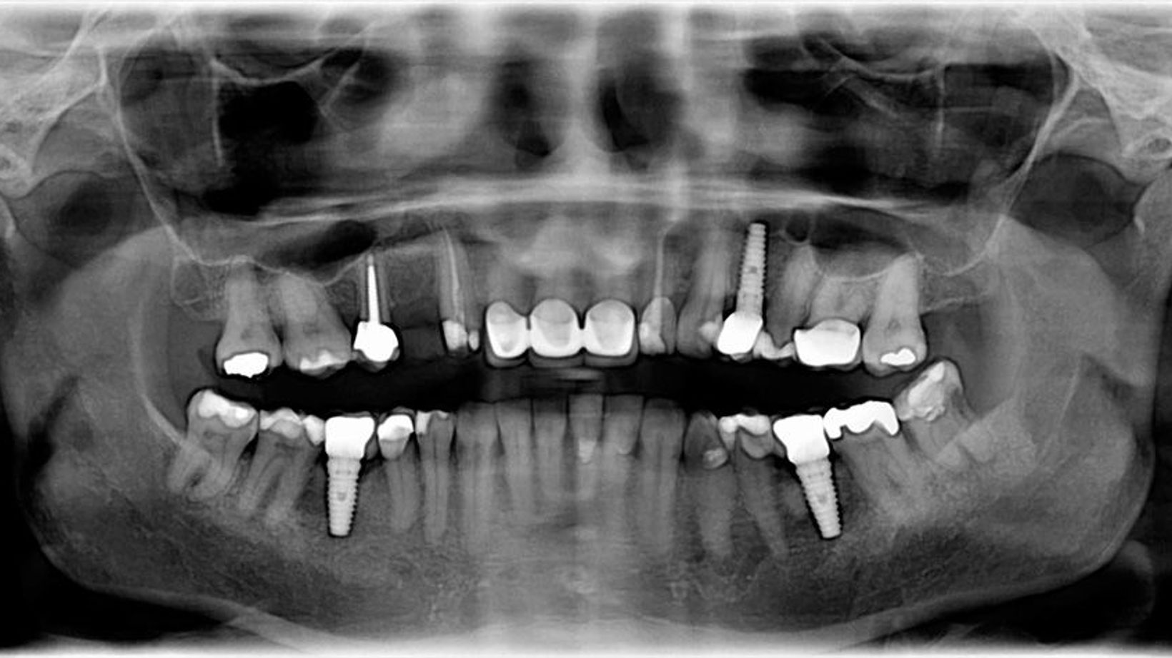 A Closer Look at the Dental Implant Timeline
