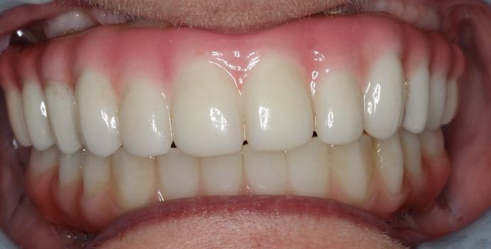 Teeth in a Day: Case 22 — after