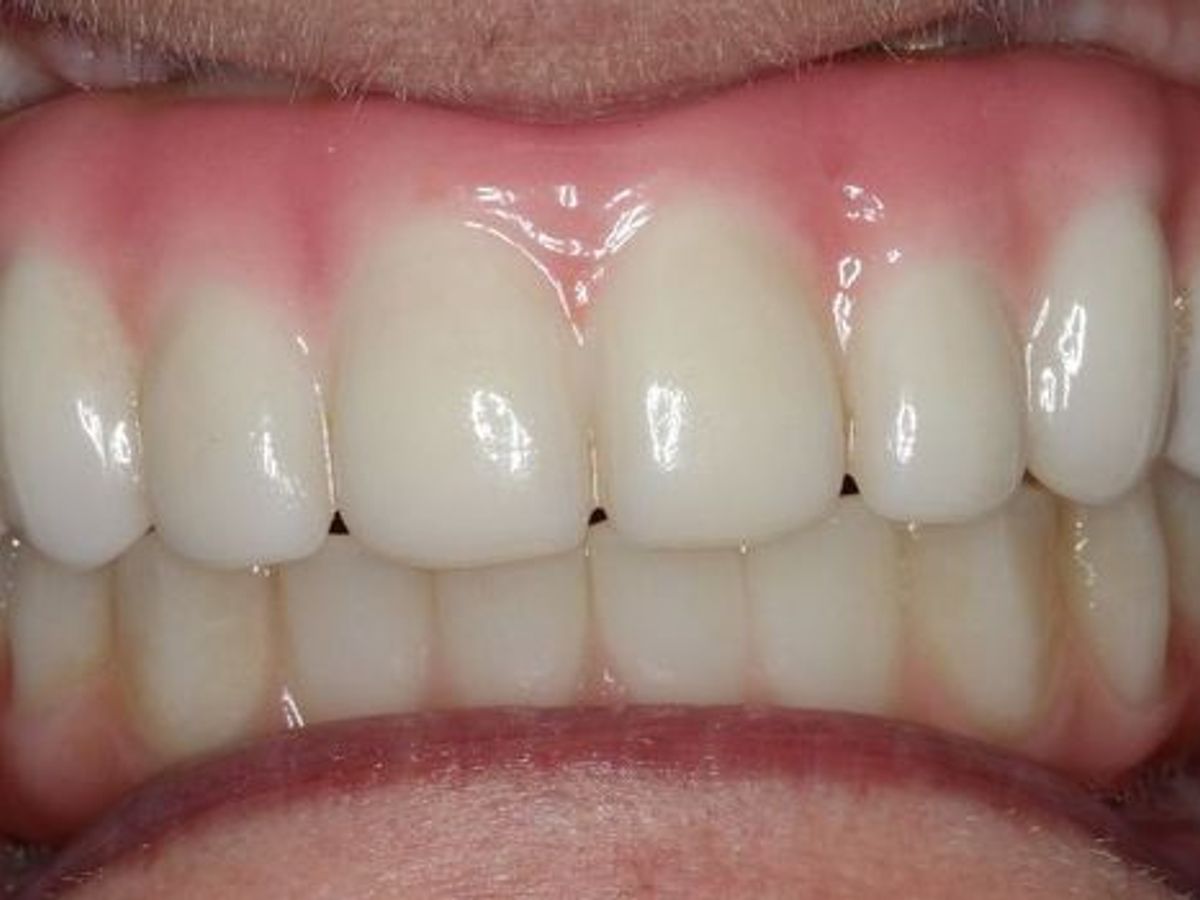 Teeth in a Day: Case 22 — after