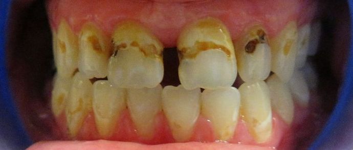Dental Crowns: Case 8 — before