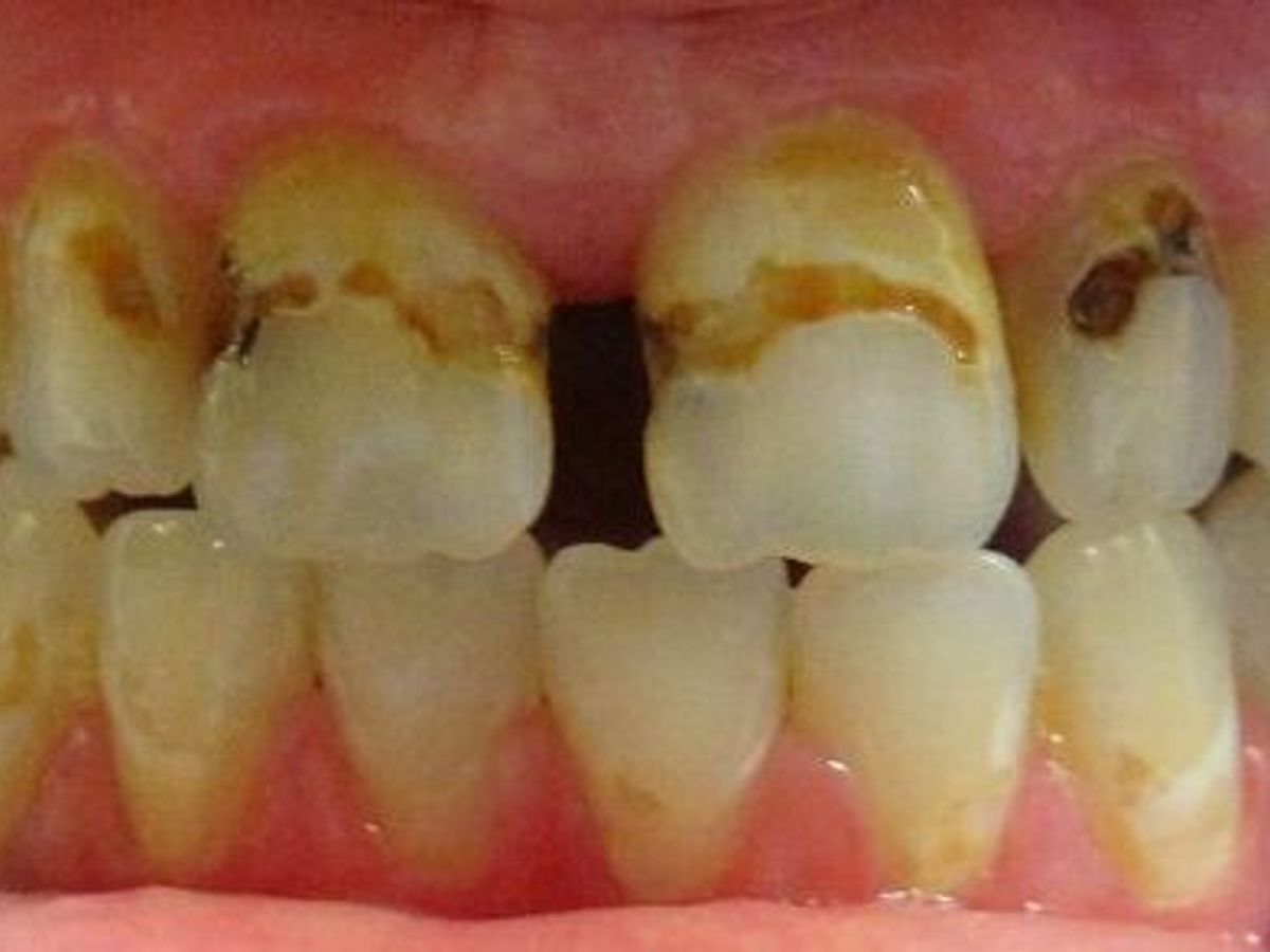 Dental Crowns: Case 8 — before