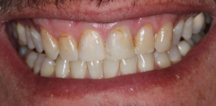 Veneers: Case 4 — before
