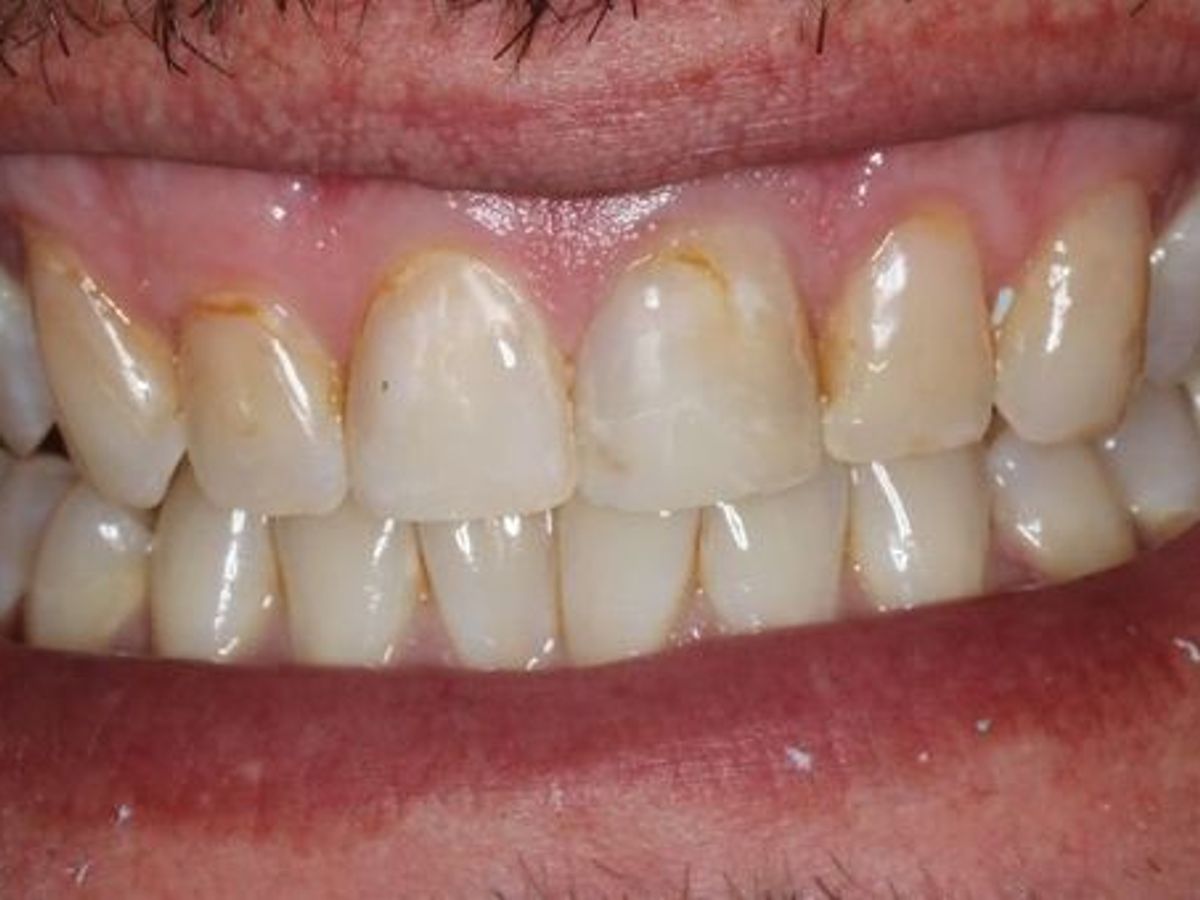 Veneers: Case 4 — before