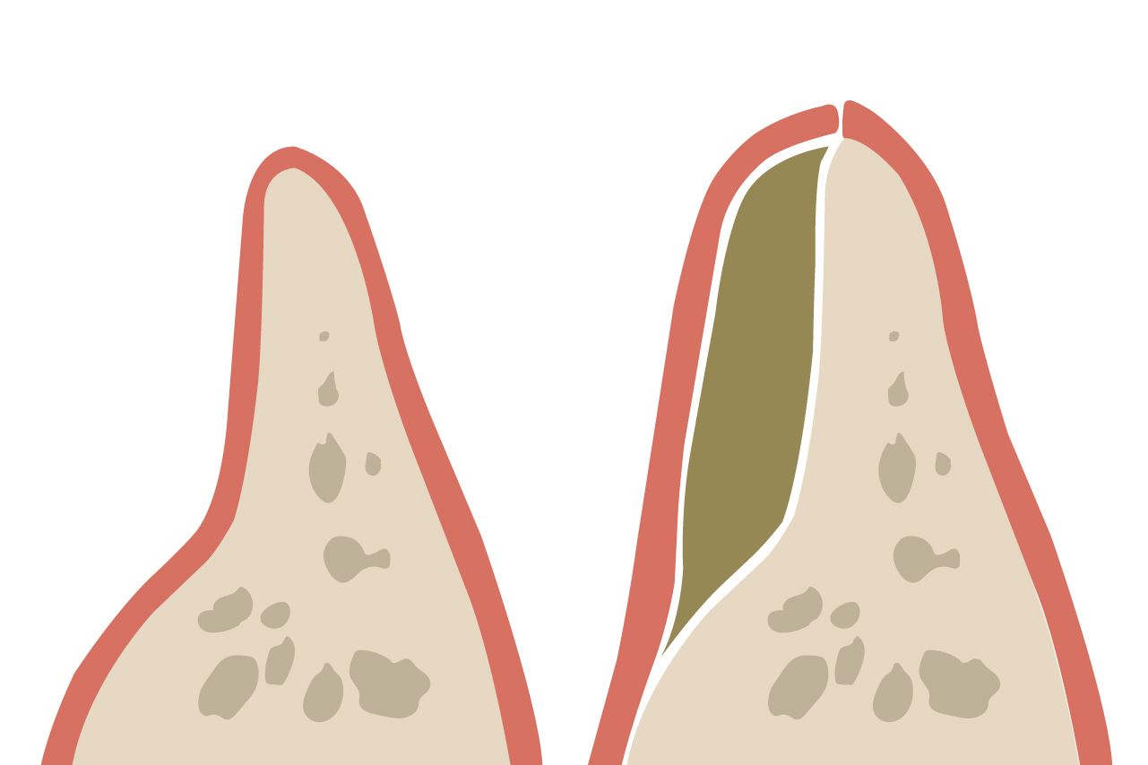 Treating Gum Disease and Jawbone Loss