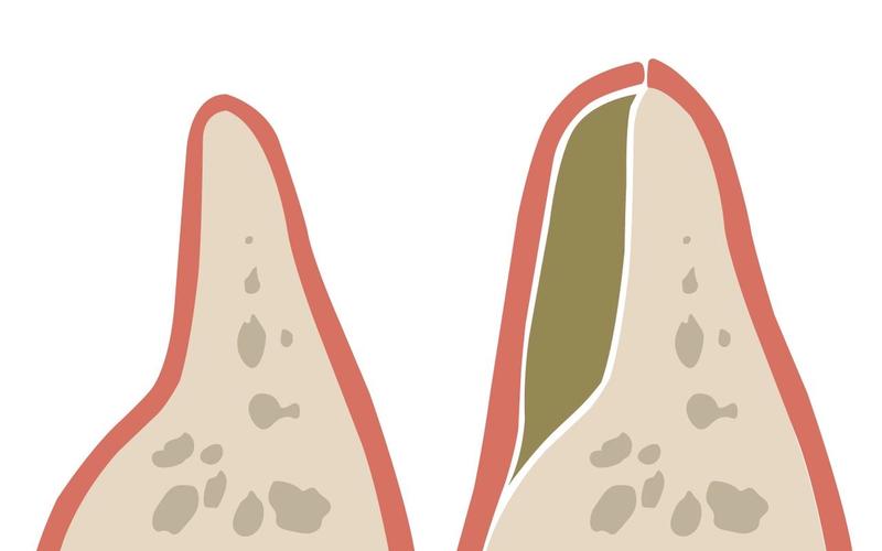 Treating Gum Disease and Jawbone Loss