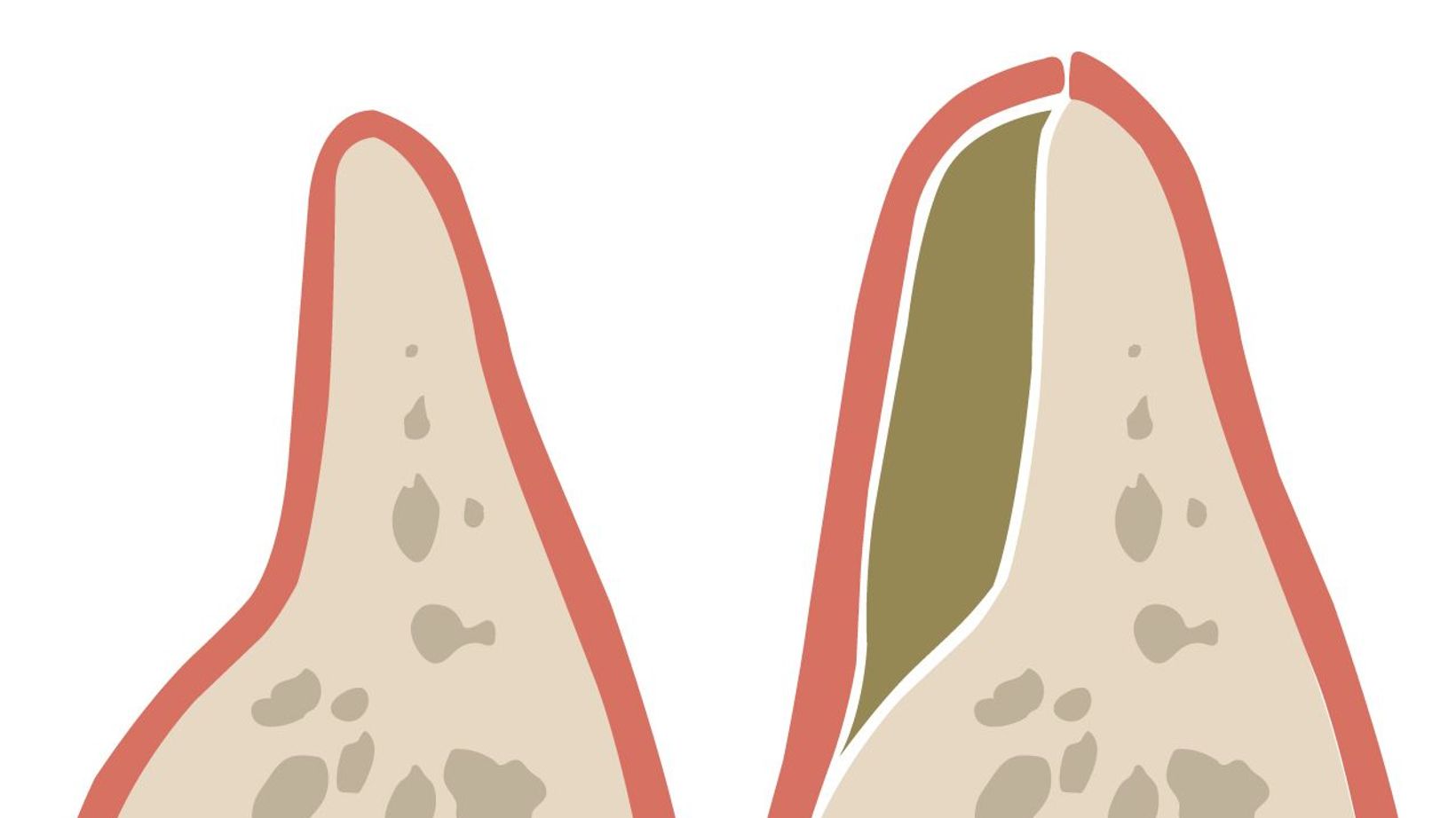 Treating Gum Disease and Jawbone Loss
