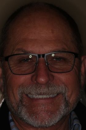 Full Mouth Reconstruction: Case 6 — after