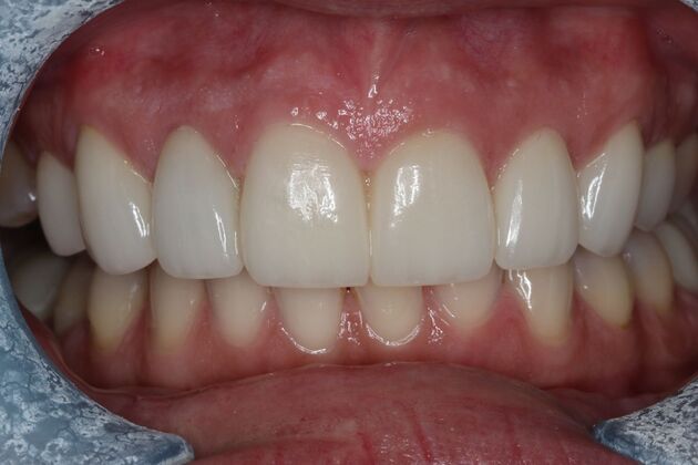 Veneers: Case 29 — after