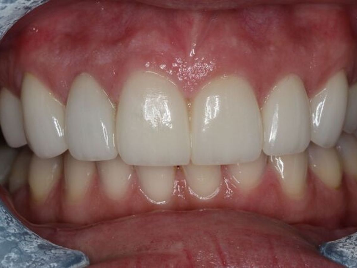 Veneers: Case 29 — after