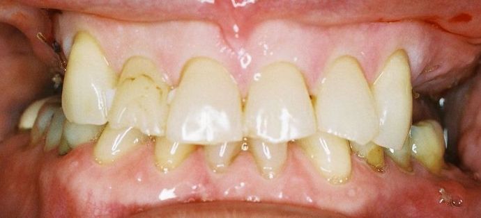 Dental Crowns: Case 9 — before