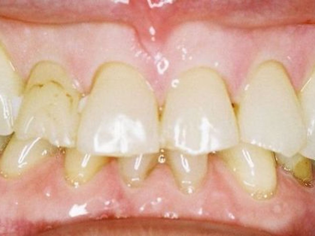 Dental Crowns: Case 9 — before