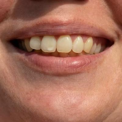 worn down teeth