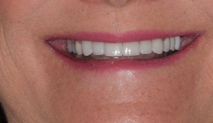 Dental Crowns: Case 26 — after